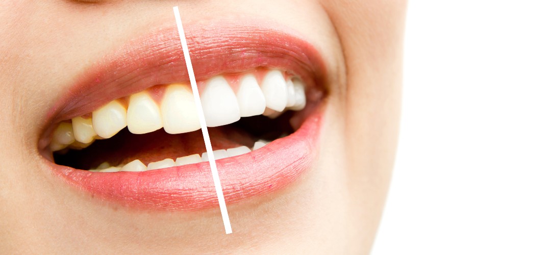 karbonat diş beyazlatma